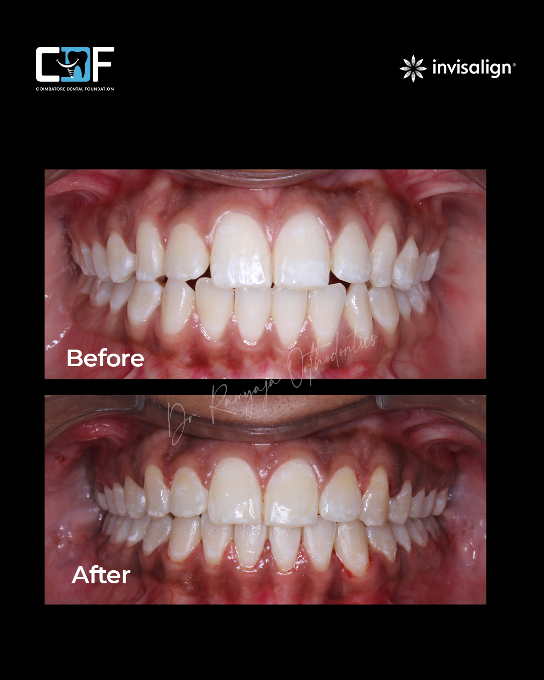 Before After Result